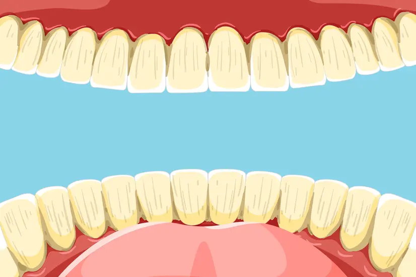 Kenapa Gigi Bisa Menguning